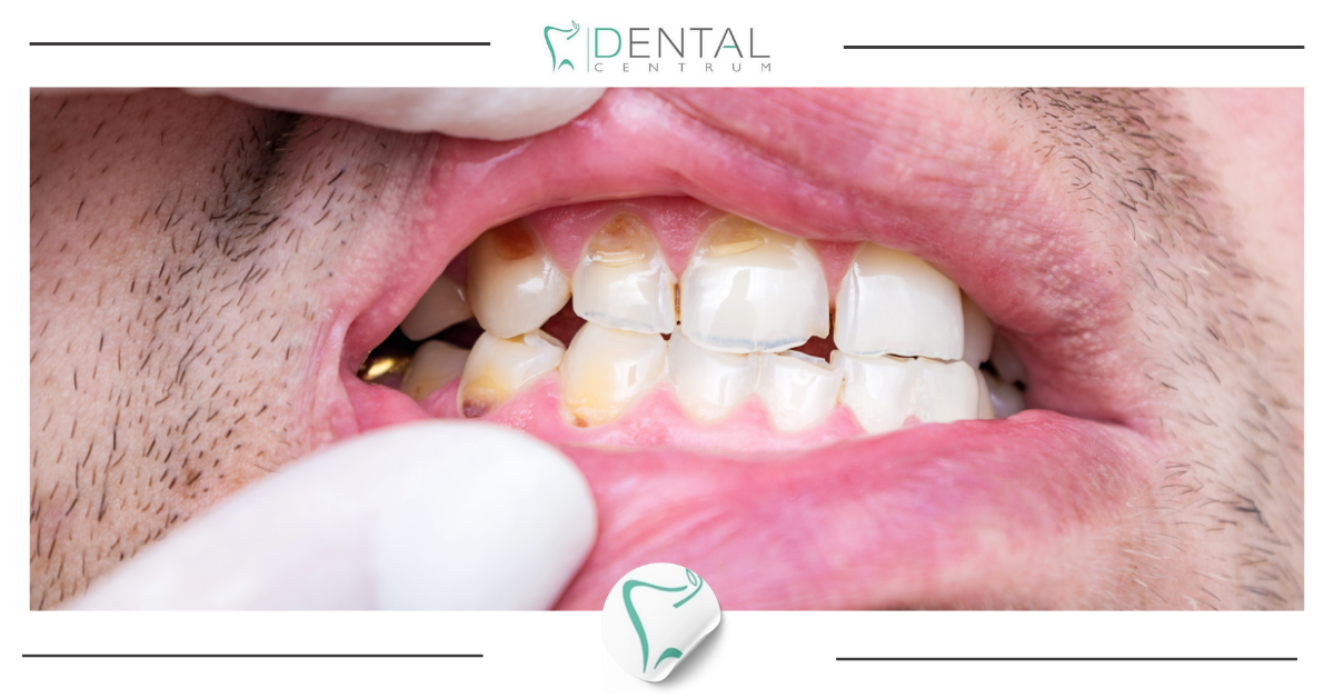 Kwasowa erozja szkliwa – na czym polega i jak ją leczyć?