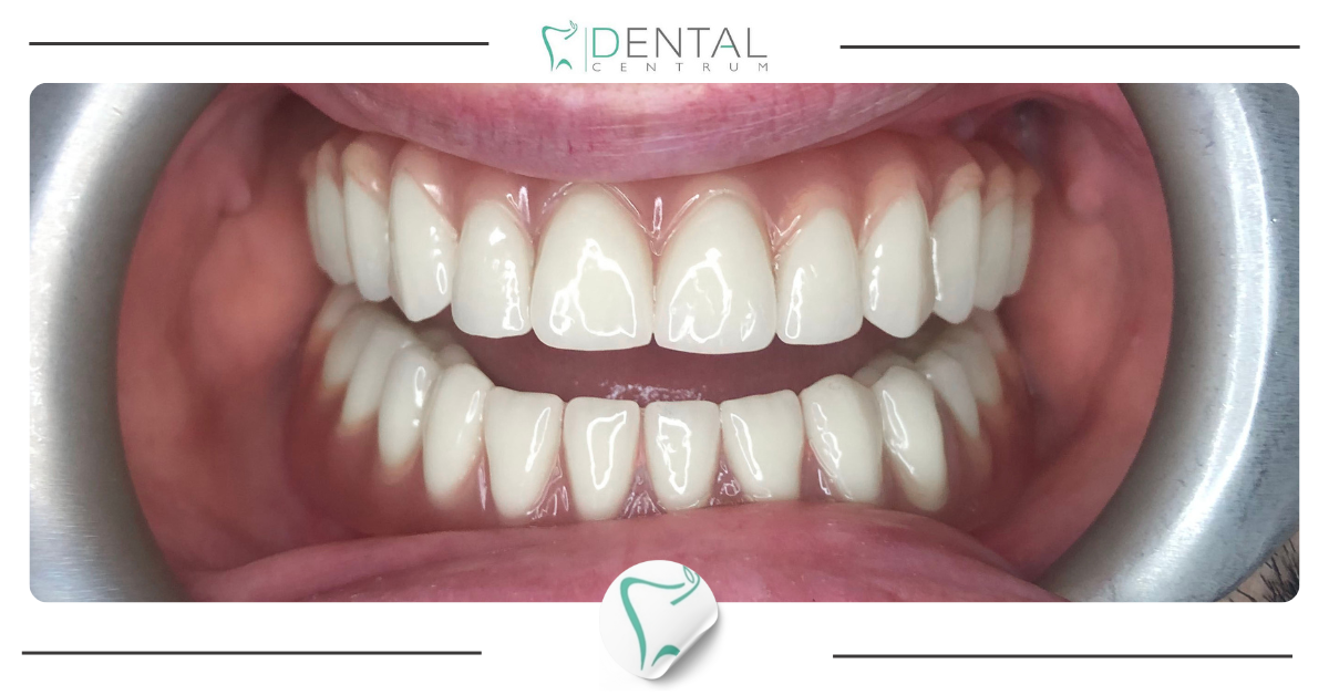 Nowy uśmiech w 1 dzień -  All-on-Four®!