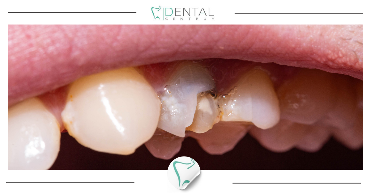 Pęknięcie wewnętrzne zęba: jak je rozpoznać?
