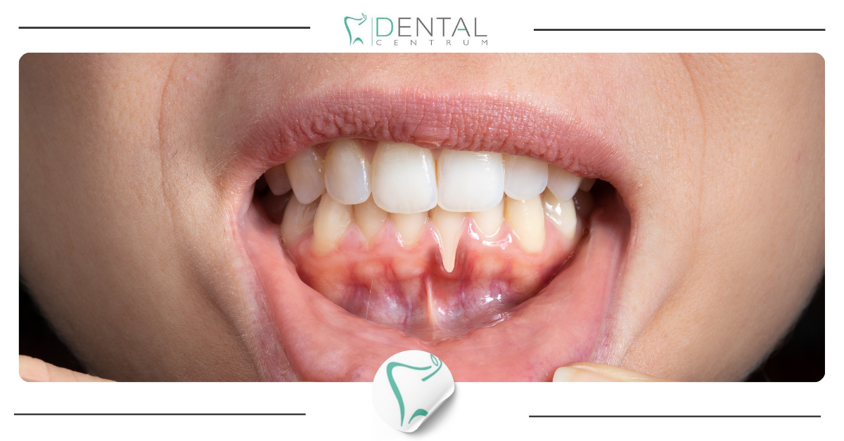 Paradontoza: objawy i leczenie