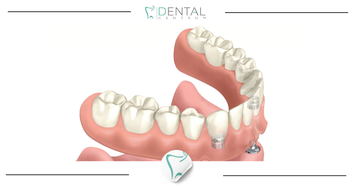Proteza na dwóch implantach – jak działa System Locator®?