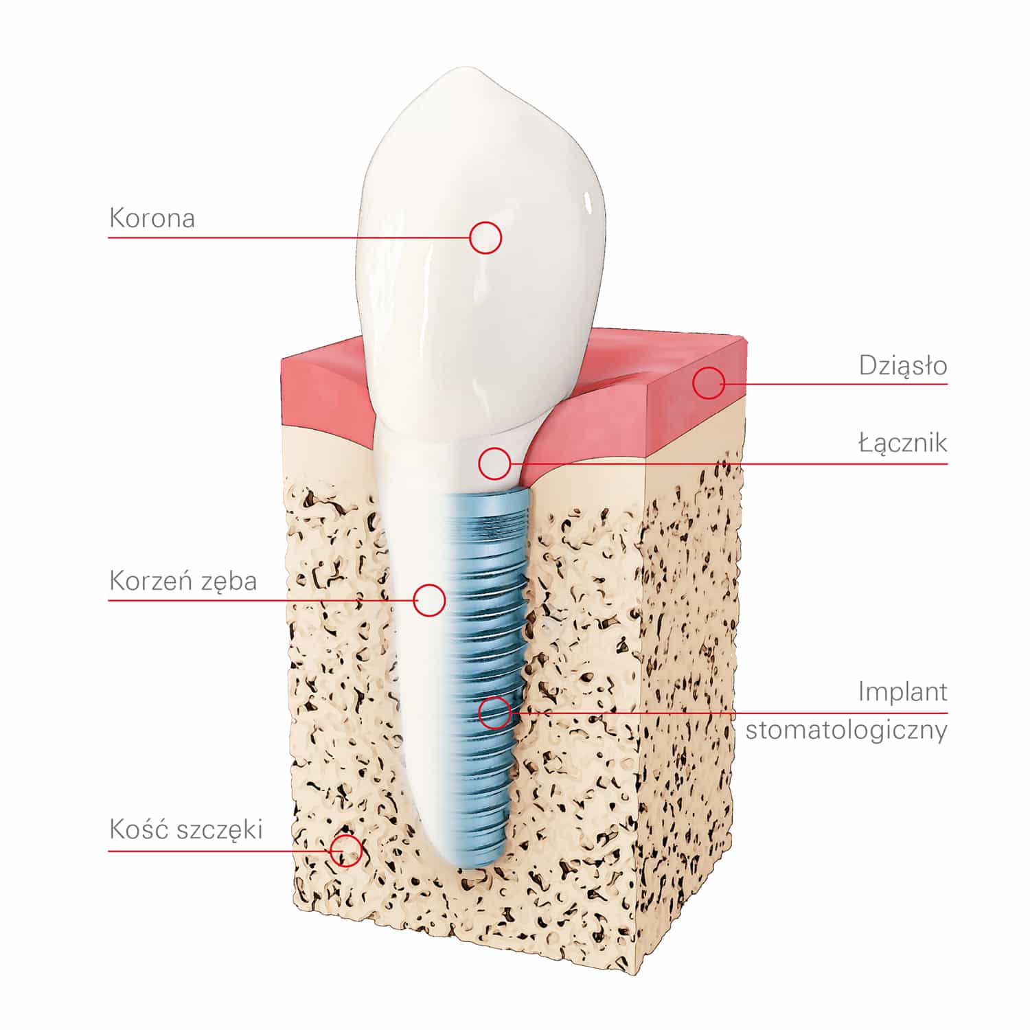 Implant Zęba Mysłowice Dentalcentrumpl 6016