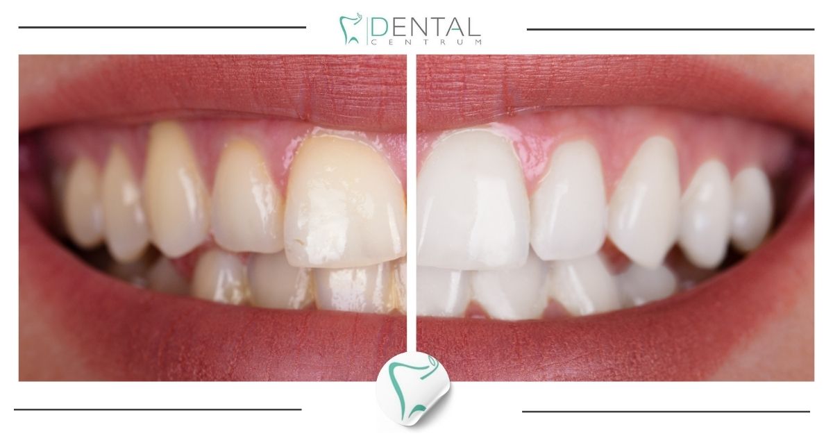 Przebarwienia zębów – jak powstają?