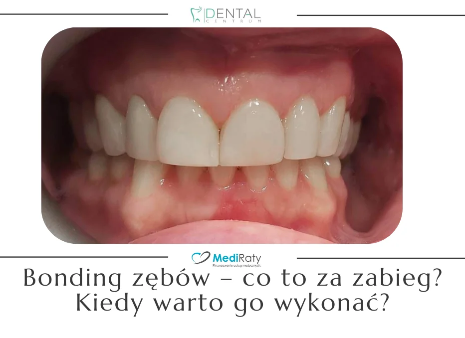 Bonding zębów – co to za zabieg? Kiedy warto go wykonać?