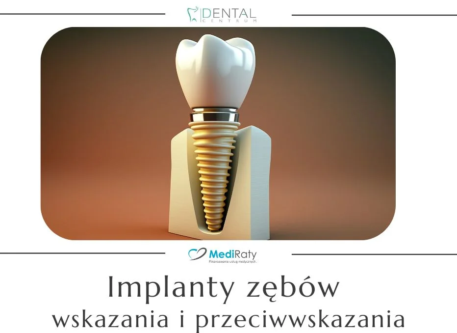 Implanty zębów – wskazania i przeciwwskazania