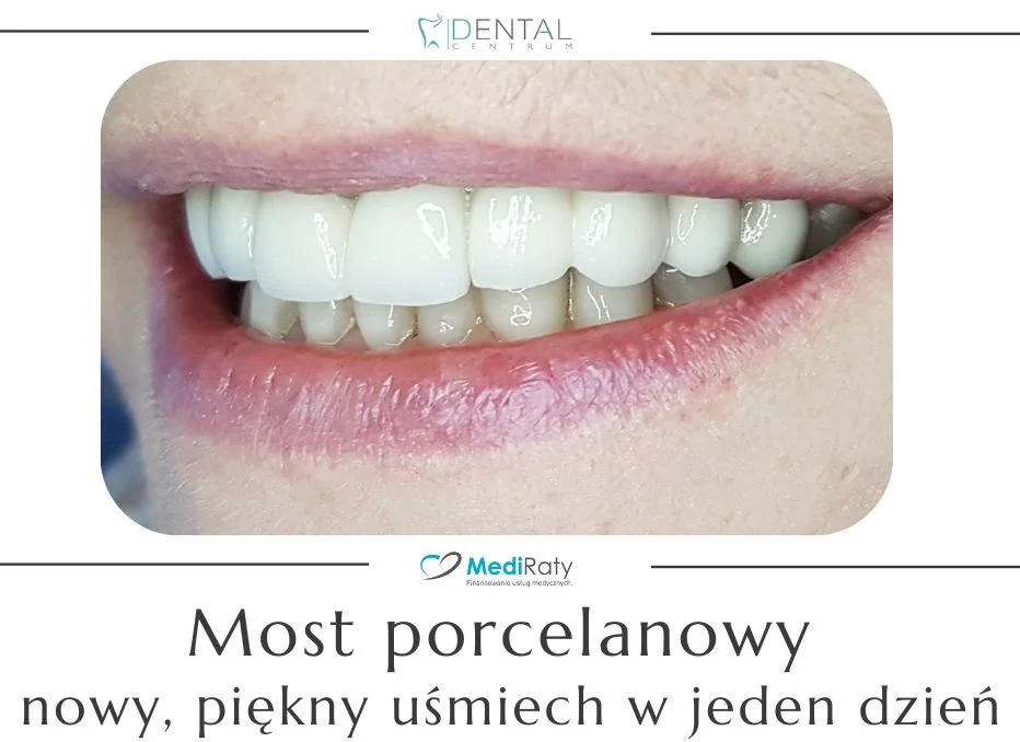 Most porcelanowy – nowy, piękny uśmiech w jeden dzień