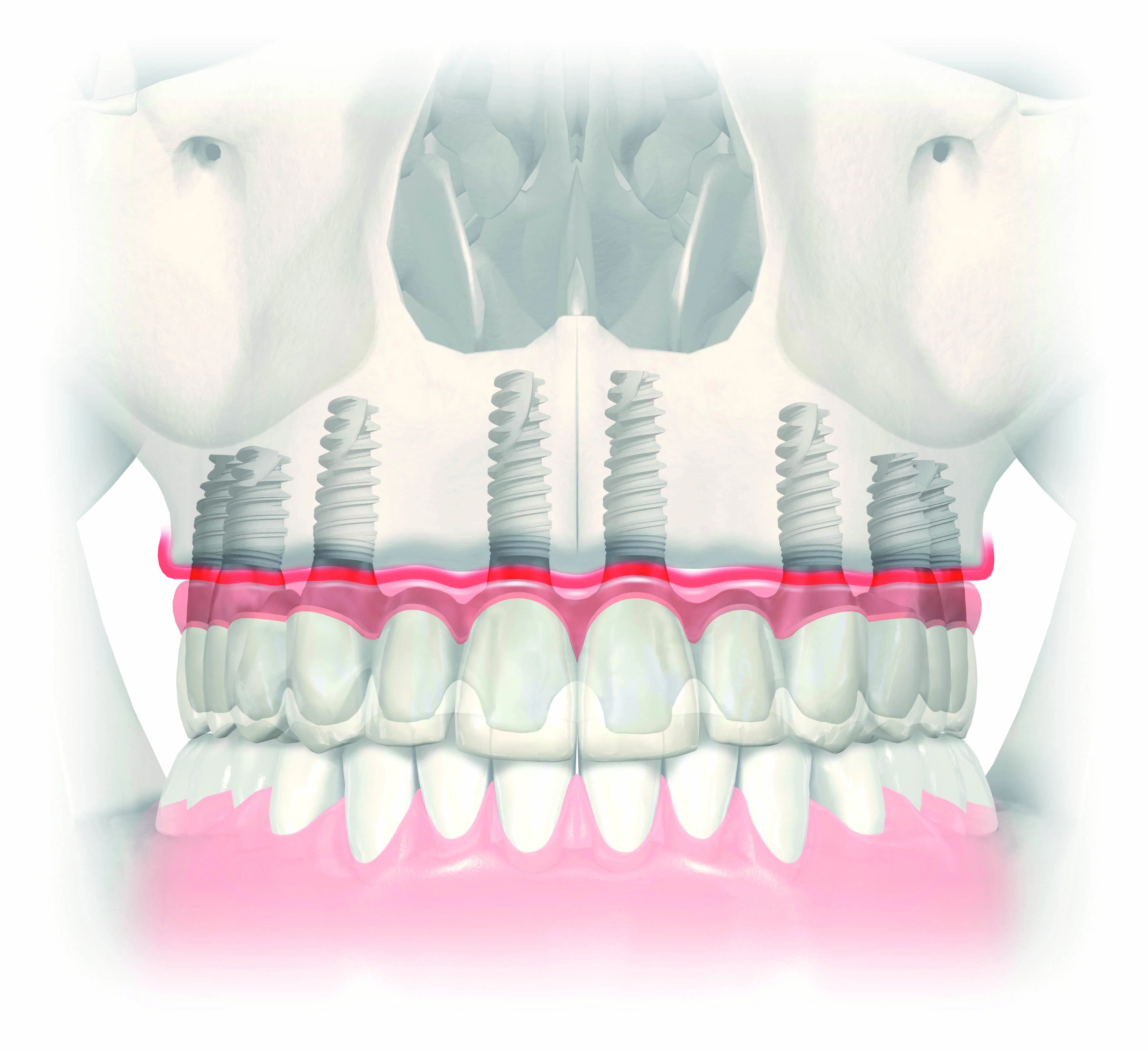 Permanent tooth reconstruction with a porcelain bridge on five or more implants
