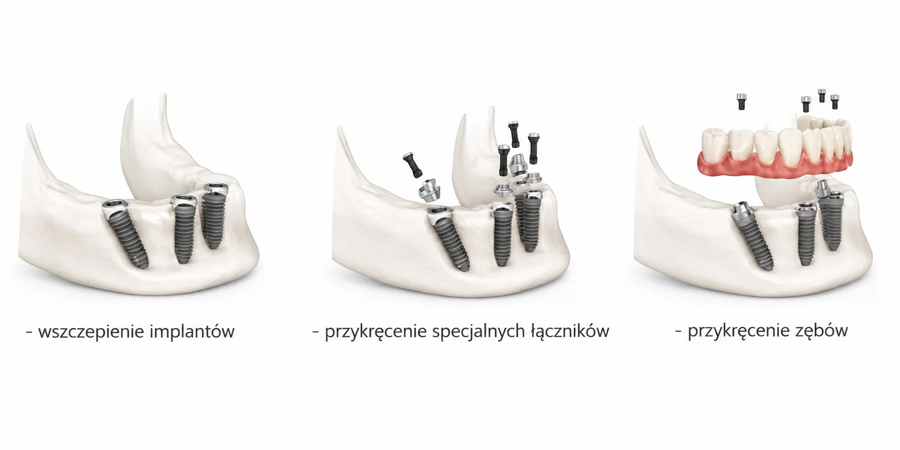 etapy-odbudowy-zebow-all-on-x-na-implantach.png