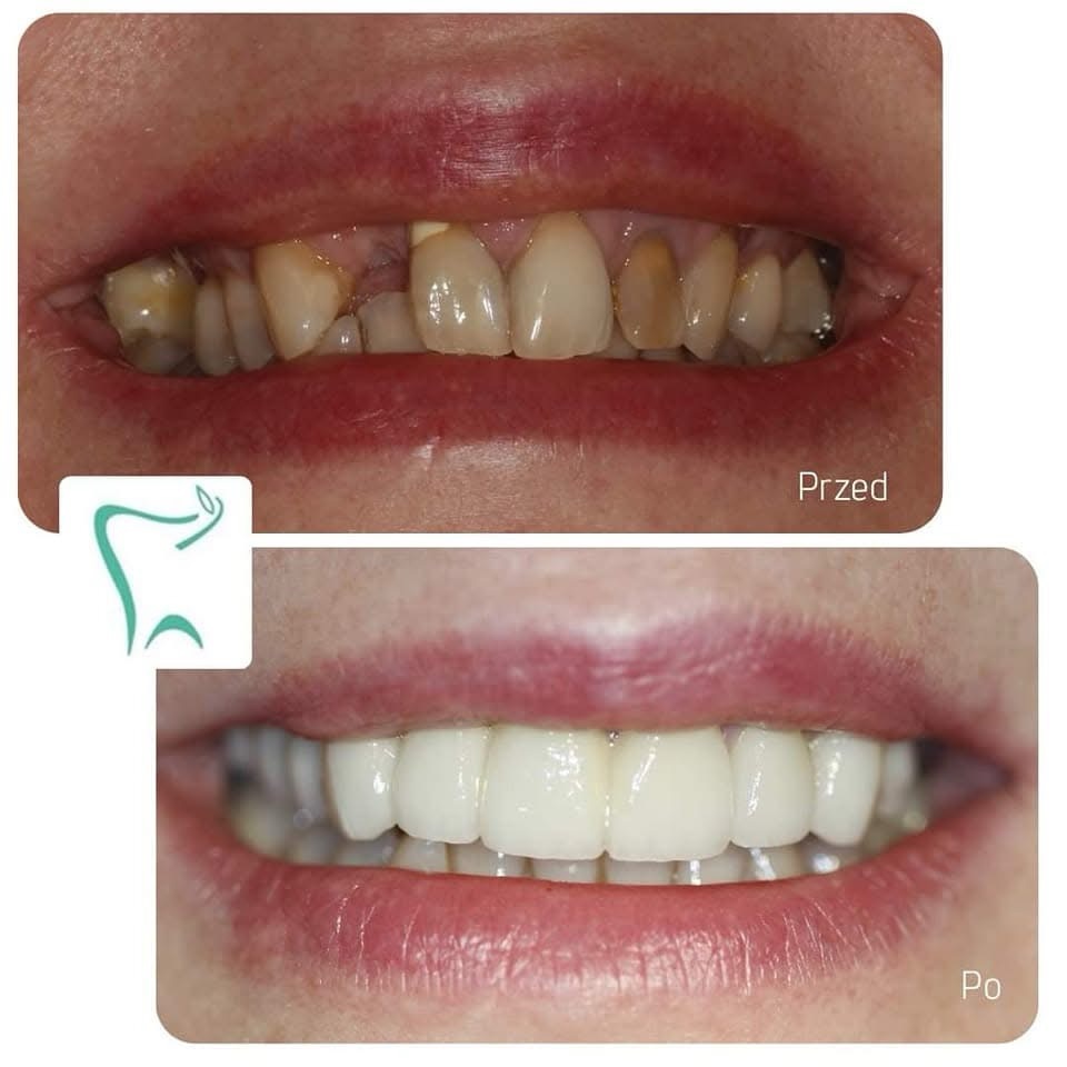 Zęby w 1 Dzień - Licówki i korony porcelanowe zeby-w-1-dzien-korony-cyrkonowe.jpg